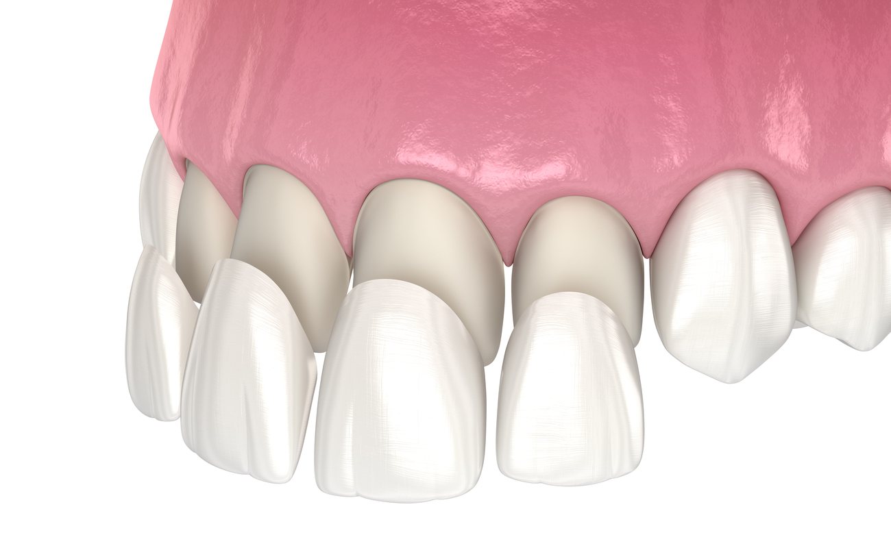 Aesthetic Dental Treatment