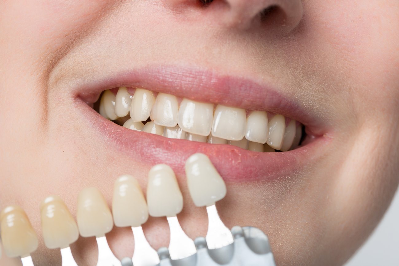 Discolouration and tooth whitening