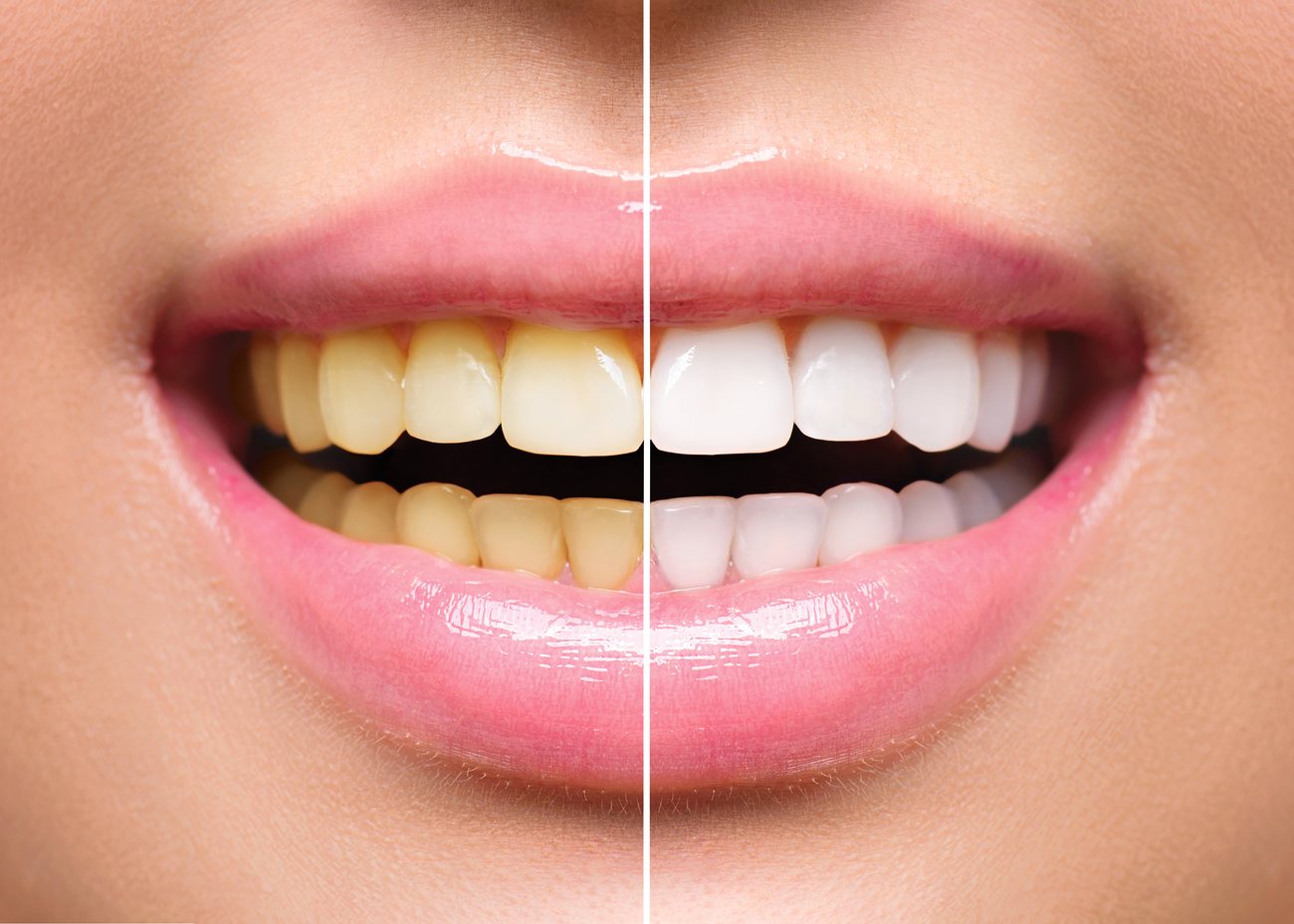 Professional Dental Cleaning