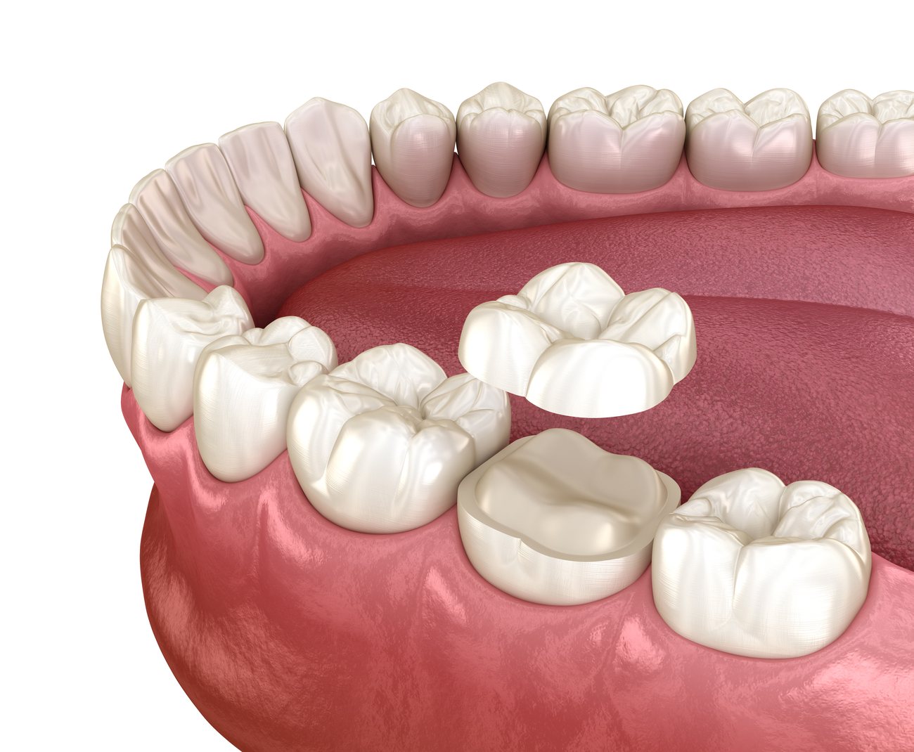 Preserving Your Own Teeth