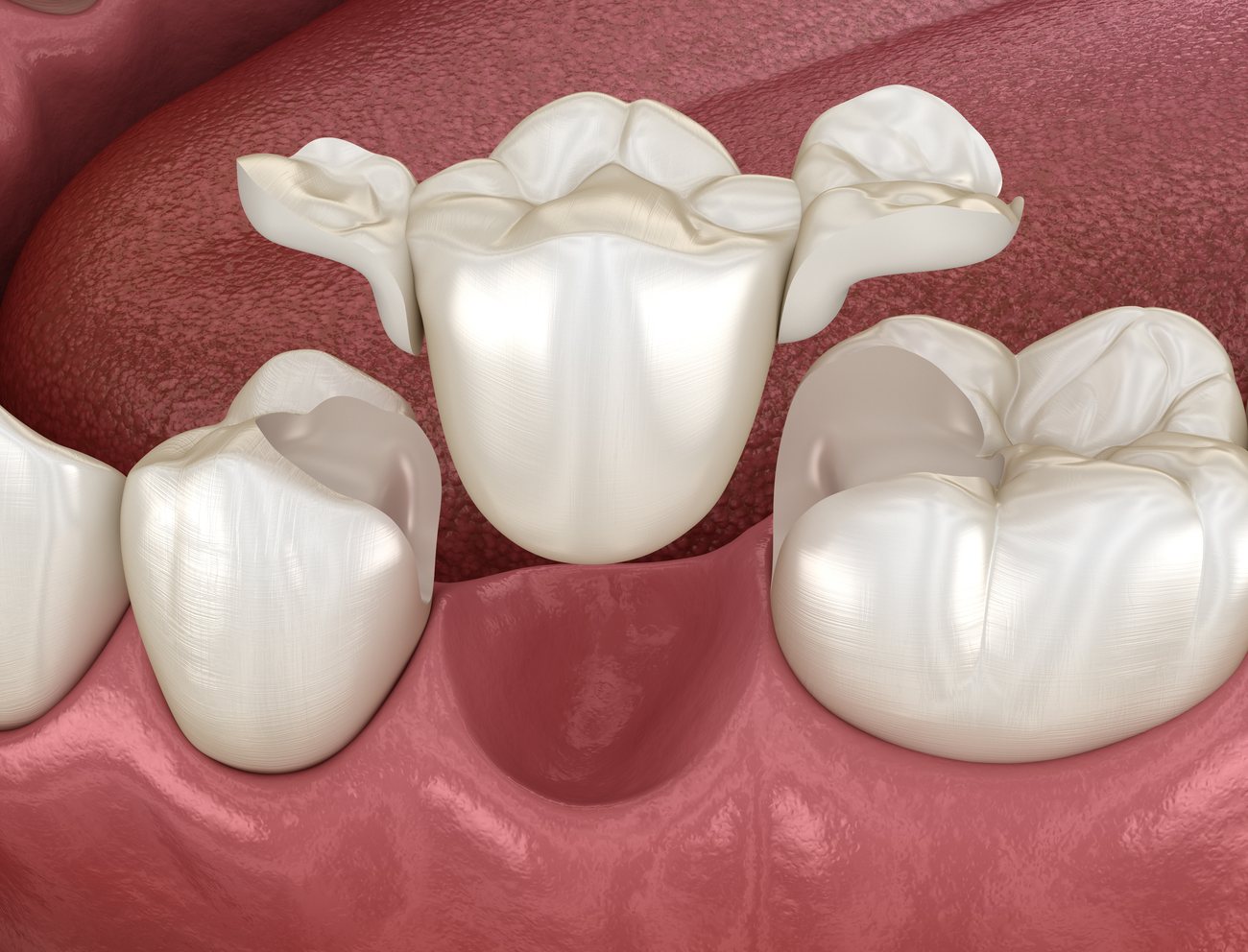 Tooth Replacement at a Glance