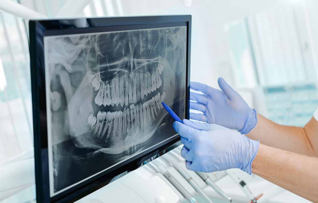 What to do after a tooth extraction