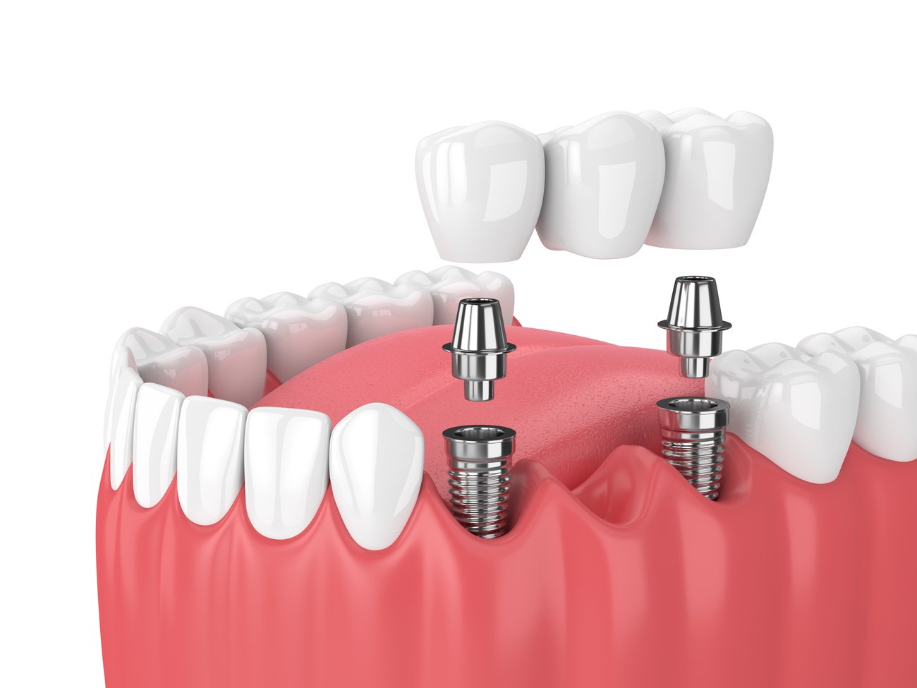 All About Dental Implants